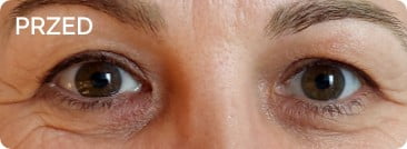 Przed zabiegiem plastyki powiek