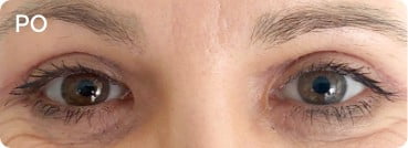 Po zabiegu plastyki powiek